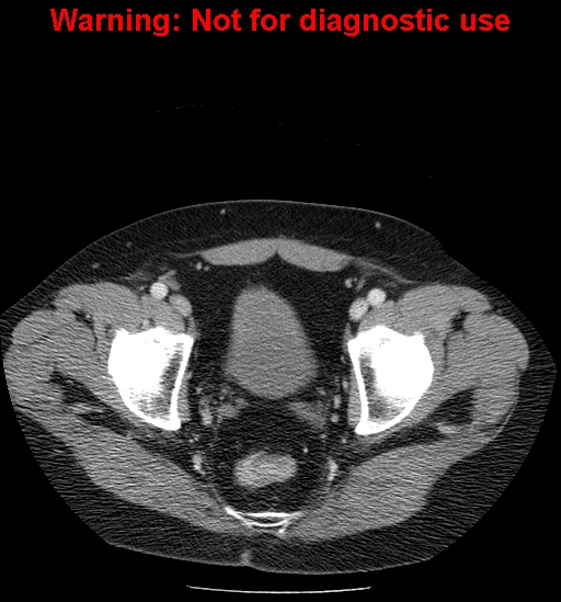 File:Bosniak renal cyst - type IV (Radiopaedia 23402-23466 D 73).jpg