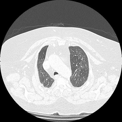 Bovine aortic arch - right internal mammary vein drains into the superior vena cava (Radiopaedia 63296-71875 Axial lung window 37).jpg