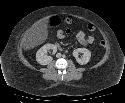 Bowel and splenic infarcts in acute lymphocytic leukemia (Radiopaedia 61055-68913 A 68).jpg
