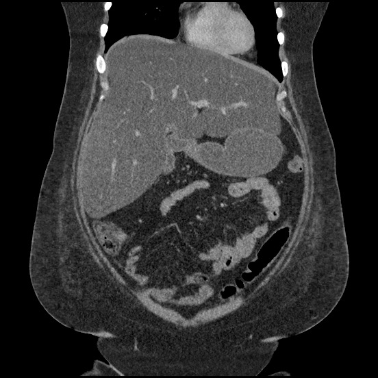 Bowel and splenic infarcts in acute lymphocytic leukemia (Radiopaedia 61055-68913 B 22).jpg