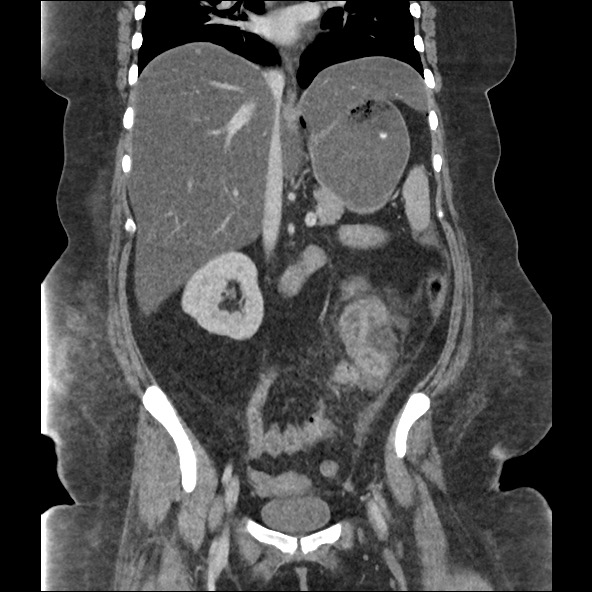 File:Bowel and splenic infarcts in acute lymphocytic leukemia (Radiopaedia 61055-68915 B 33).jpg