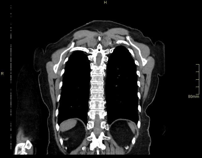 Brachial artery foreign body (Radiopaedia 54583-60820 Coronal non-contrast 49).jpg