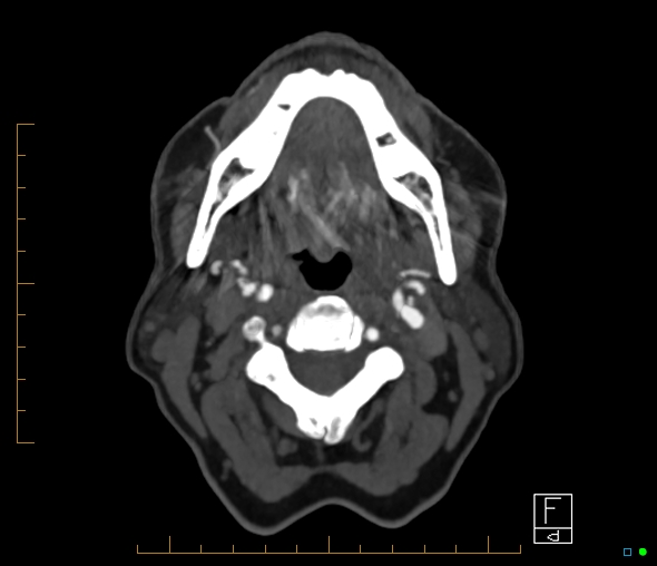 Brachiocephalic trunk stenosis (Radiopaedia 87242-103519 A 81).jpg