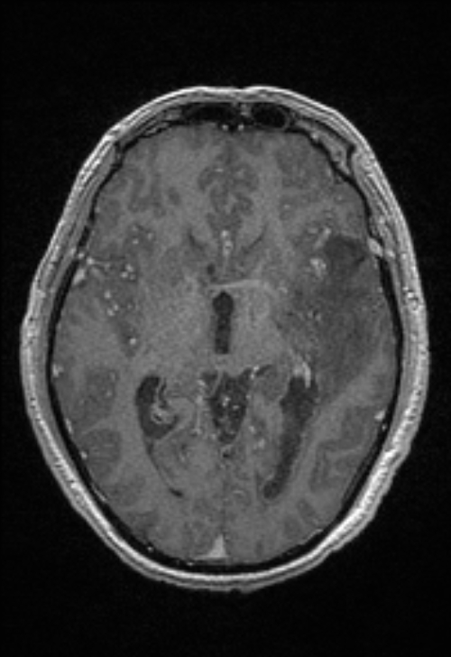 Brain abscess with ventriculitis (Radiopaedia 85703-101495 Axial T1 C+ 87).jpg