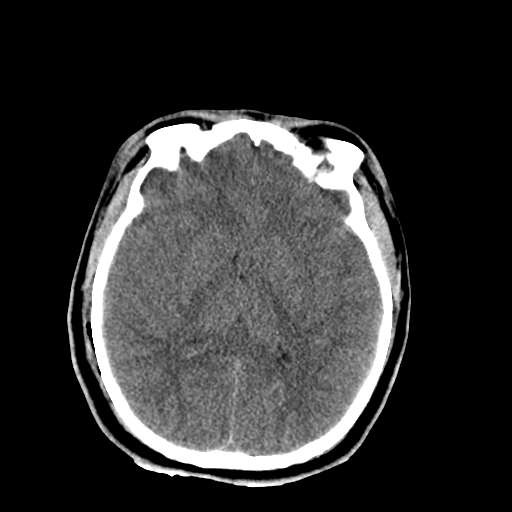 File:Brain contusions, internal carotid artery dissection and base of skull fracture (Radiopaedia 34089-35339 Axial non-contrast 30).png