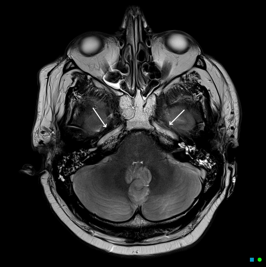 File:Brain death on MRI and CT angiography (Radiopaedia 42560-45689 Axial T2 9).jpg