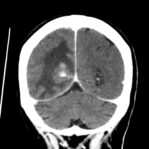 File:Brain metastases from breast cancer (Radiopaedia 23178-23231 D 30).jpg