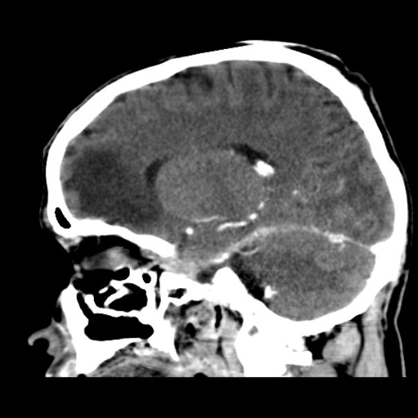 Brain metastases from lung cancer (Radiopaedia 24480-24781 C+ delayed 36).jpg