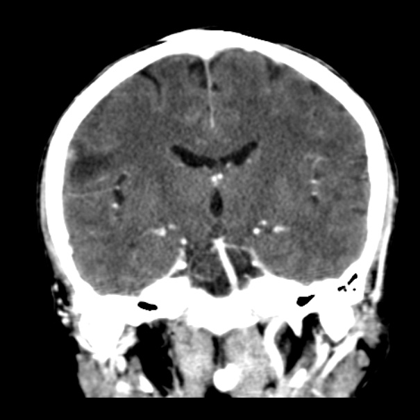 Brain metastases from lung cancer (Radiopaedia 24480-24781 Coronal C+ delayed 33).jpg
