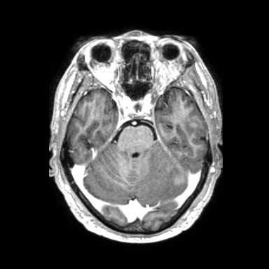 Brain metastases from lung cancer (Radiopaedia 83839-99028 Axial T1 C+ 18).jpg