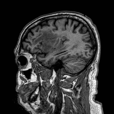 Brain metastases from lung cancer (Radiopaedia 83839-99028 Sagittal T1 31).jpg