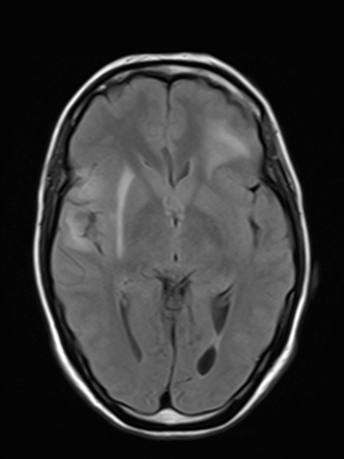 File:Brain metastasis as initial presentation of non-small cell lung cancer (Radiopaedia 65122-74126 Axial FLAIR 10).jpg