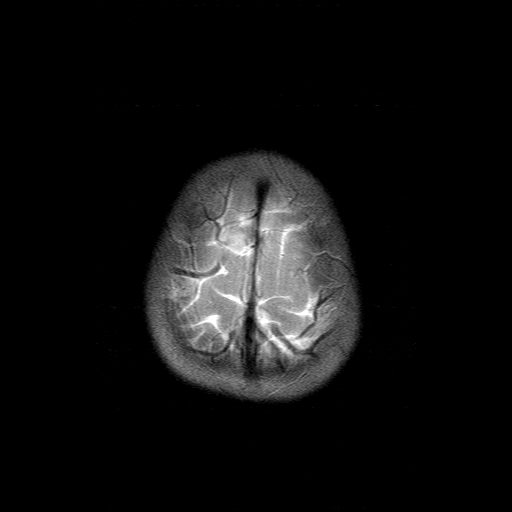 File:Brainstem ganglioglioma (Radiopaedia 10763-11224 Axial T2 2).jpg