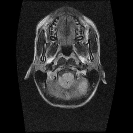 File:Brainstem glioma (Radiopaedia 30923-31624 Axial FLAIR 2).jpg