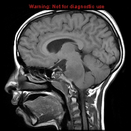 File:Brainstem glioma (Radiopaedia 9444-10124 Sagittal T1 4).jpg