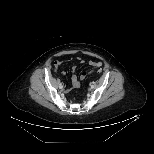 File:Breast cancer pseudocirrhosis with lobar invovlement (Radiopaedia 81080-94670 A 127).jpg