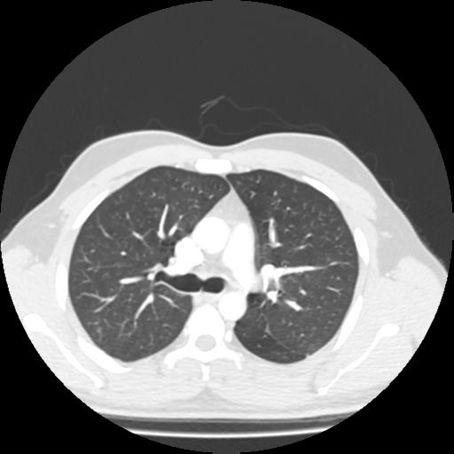 Bronchial carcinoid (Radiopaedia 80013-93291 Axial lung window 39).jpg