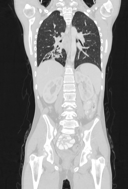 Bronchial carcinoid tumor (Radiopaedia 57187-64090 Coronal lung window 67).jpg