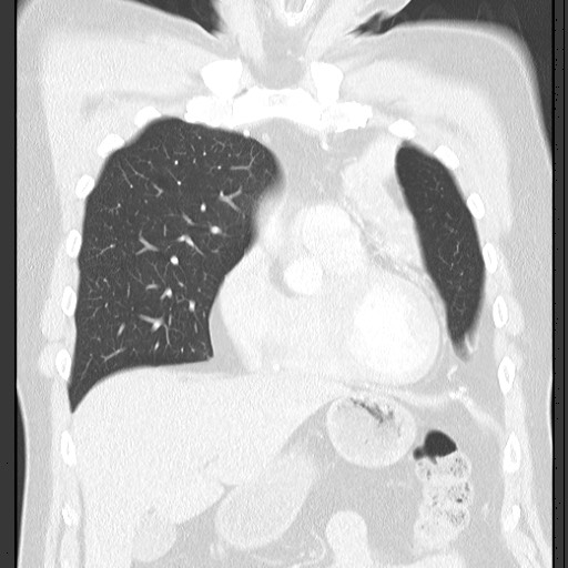 Bronchial carcinoid tumor (Radiopaedia 67377-76764 Coronal lung window 26).jpg