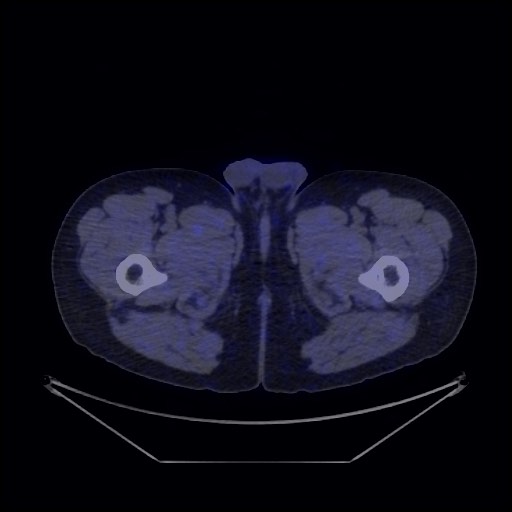 Bronchial carcinoid tumor (Radiopaedia 67377-76765 68Ga-DOTATATE PET-CT 79).jpg