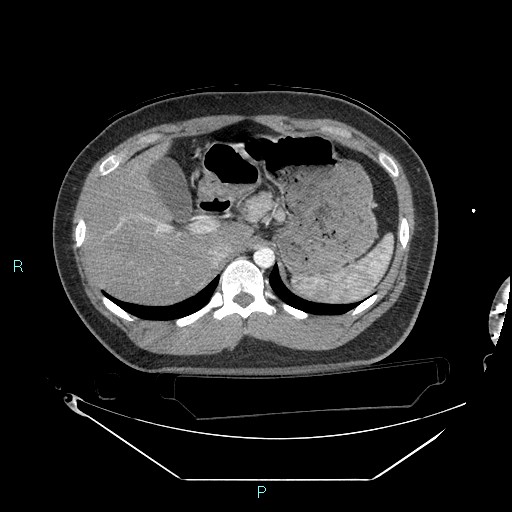 Bronchial carcinoid tumor (Radiopaedia 78272-90870 B 117).jpg