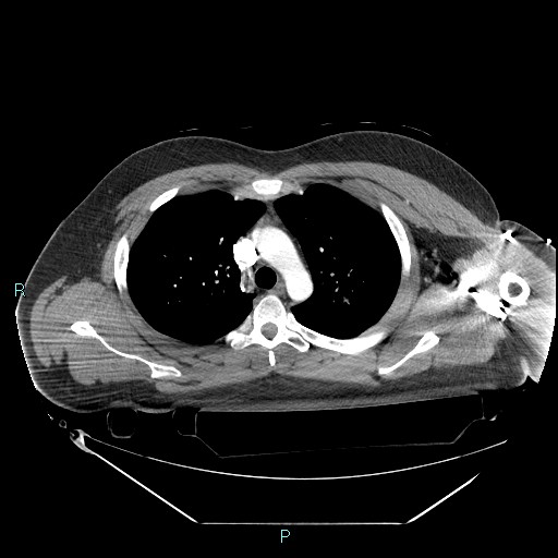 Bronchial carcinoid tumor (Radiopaedia 78272-90870 B 41).jpg