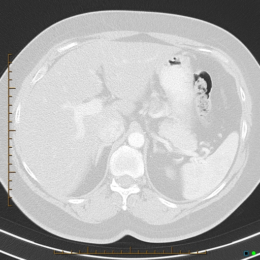 Bronchial diverticula (Radiopaedia 79512-92675 Axial lung window 50).jpg
