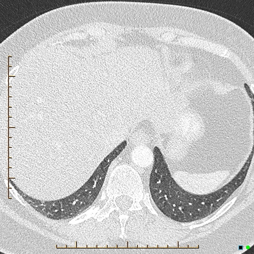 Bronchial diverticula (Radiopaedia 79512-92676 Axial lung window 179).jpg