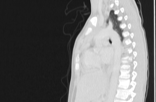 Bronchial mucoepidermoid carcinoma (Radiopaedia 57023-63895 Sagittal lung window 99).jpg