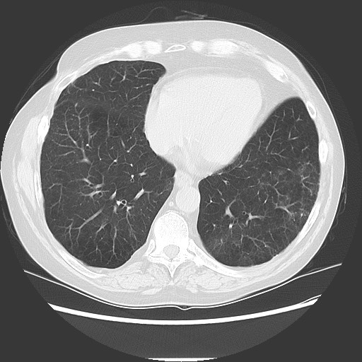 Bronchial stenosis - lung transplant (Radiopaedia 73133-83848 Axial lung window 45).jpg