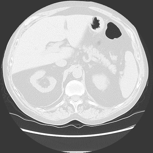 Bronchial stenosis - lung transplant (Radiopaedia 73133-83848 Axial lung window 61).jpg