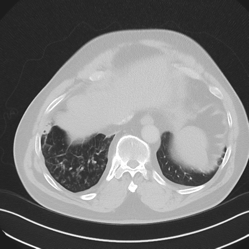 File:Bronchiectasis (Radiopaedia 39385-41666 Axial lung window 53).png