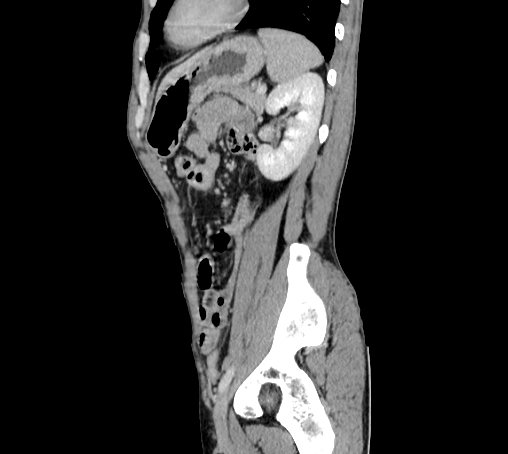 File:Bronchiectasis in Crohn disease (Radiopaedia 60311-67977 D 84).jpg