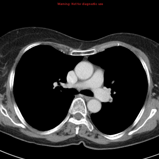 File:Bronchoalveolar carcinoma (BAC) (Radiopaedia 13436-13392 B 23).jpg