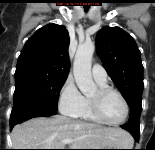 Bronchoalveolar carcinoma (BAC) (Radiopaedia 13436-13392 E 20).jpg
