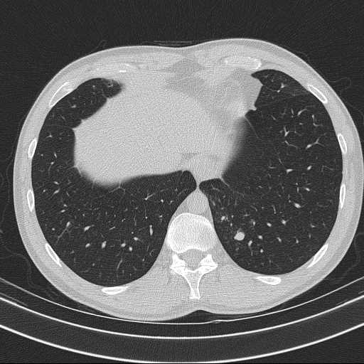 Bronchocele (Radiopaedia 60676-68429 Axial lung window 60).jpg