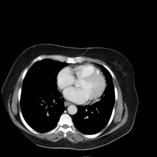 Bronchogenic carcinoma (Radiopaedia 73497-84262 A 42).jpg