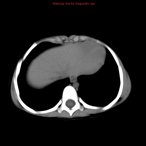 File:Bronchogenic cyst (Radiopaedia 9372-10063 Axial non-contrast 14).jpg
