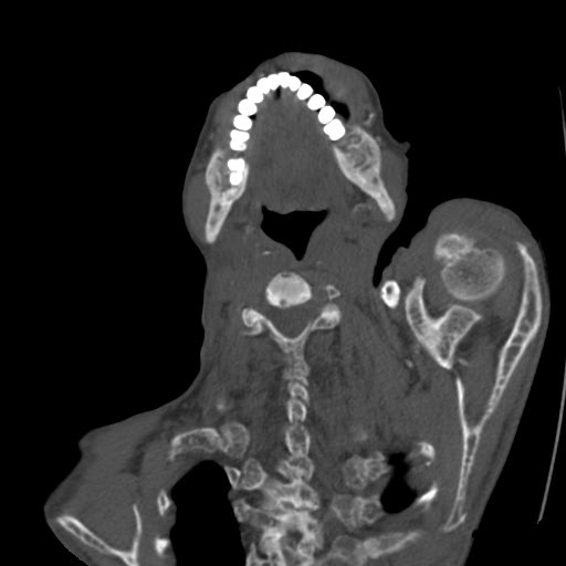 File:Brown tumor with secondary hyperparathyroidism (Radiopaedia 23591-23705 C 15).jpg