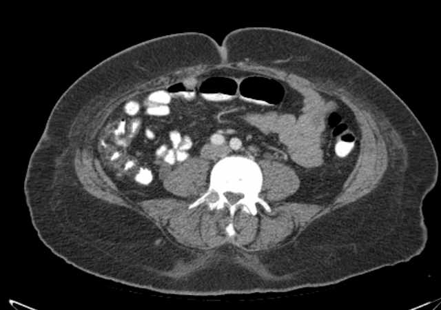 Brown tumors compressing the spinal cord (Radiopaedia 68442-77988 E 74).jpg