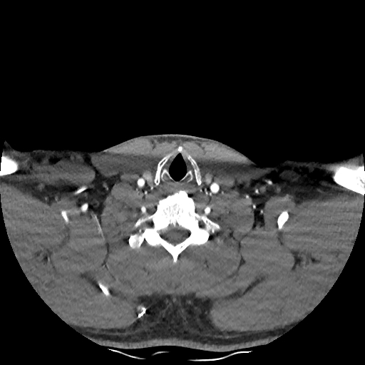 Buccal fat pad arteriovenous malformation (Radiopaedia 70936-81144 D 78).jpg