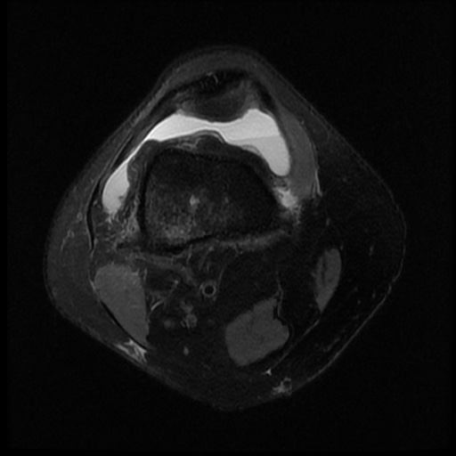 File:Bucket handle meniscus tear (Radiopaedia 56916-63751 Axial PD fat sat 2).jpg