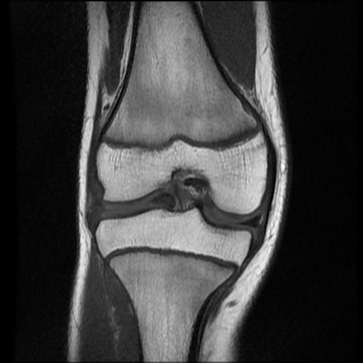 File:Bucket handle tear - lateral meniscus (Radiopaedia 72124-82634 Coronal T1 9).jpg