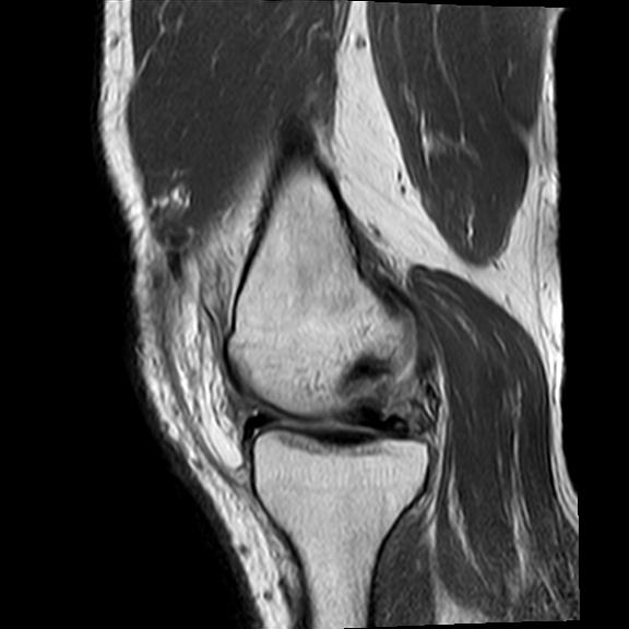 File:Bucket handle tear - medial meniscus (Radiopaedia 29250-29664 Sagittal PD 14).jpg