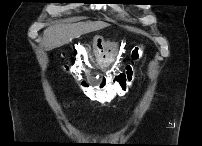 File:Buried bumper syndrome - gastrostomy tube (Radiopaedia 63843-72577 Coronal Inject 28).jpg