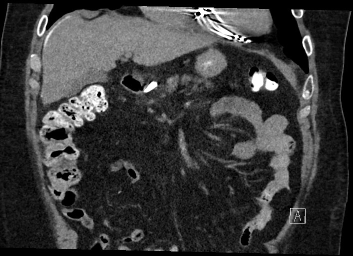 Buried bumper syndrome - gastrostomy tube (Radiopaedia 63843-72577 Coronal Inject 50).jpg