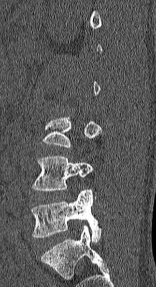 Burst fracture (Radiopaedia 53373-59357 Sagittal bone window 63).jpg