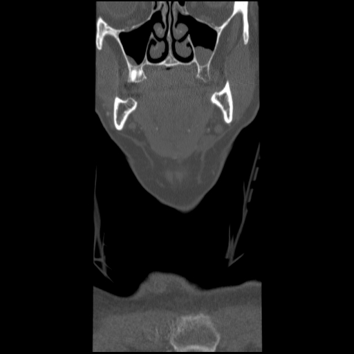 C1 anterior arch (plough) fracture - type 1 (Radiopaedia 76181-87720 Coronal bone window 95).jpg