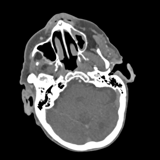 C2 fracture with vertebral artery dissection (Radiopaedia 37378-39200 A 208).png