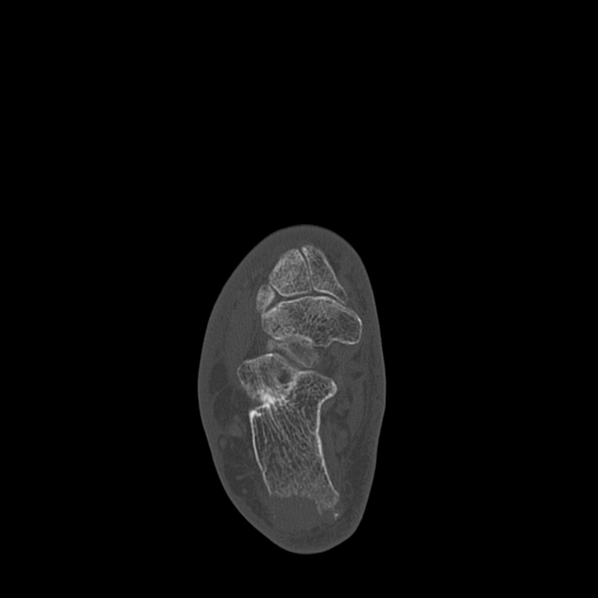 Calcaneal tuberosity avulsion fracture (Radiopaedia 22649-22668 Axial bone window 25).jpg